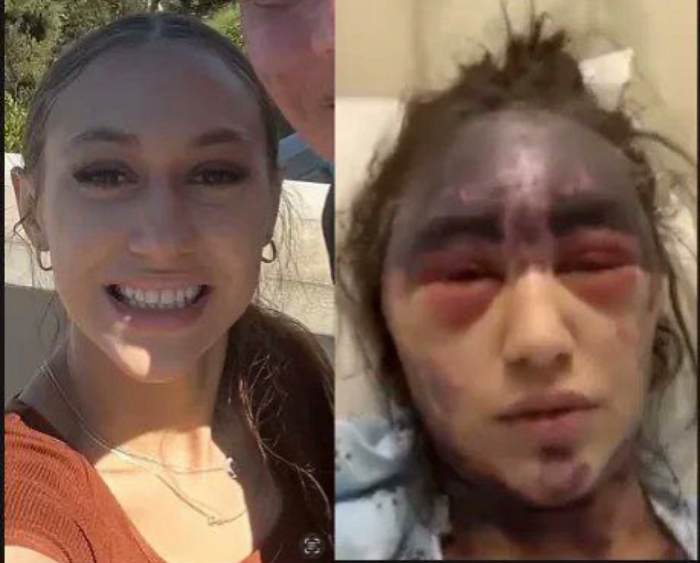 Two photos of Alexis Lorenze side by side. In the first, a healthy and attractive young woman. In the second, the same woman with dark bruising all around her scalp, neck, and face, with the area around the eyes puffed up and red, and the entire forehead purple.