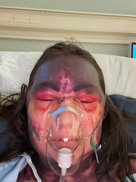 Photo of Alexis Lorenze with dark purple bruising covering her entire scalp from the eyebrows up, with similar blotching on her neck, very red puffy eyes, and wearing an oxygen mask in a hospital setting.